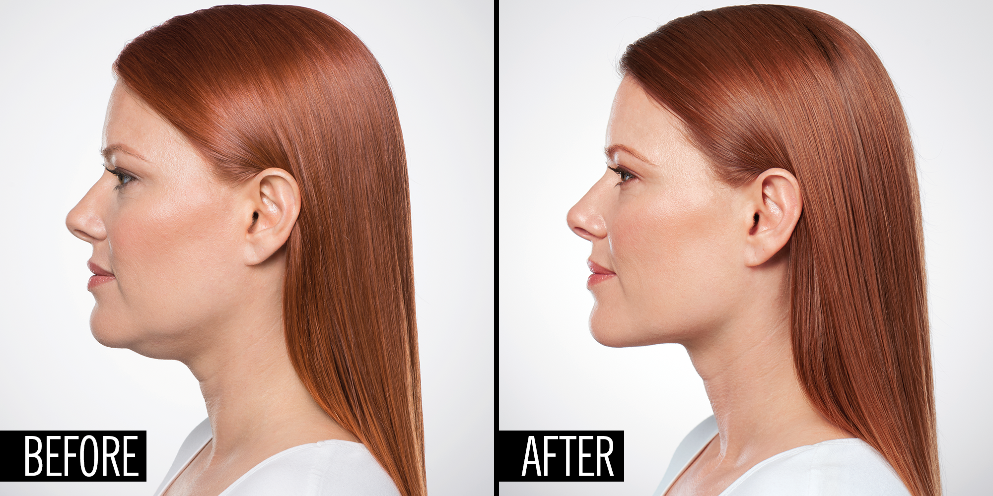Double Chin Removal Vintage Houston TX